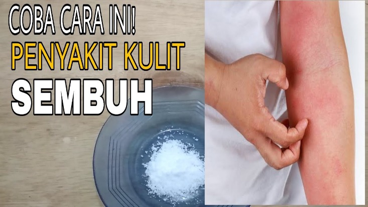 Daun Untuk Gatal-gatal Kulit